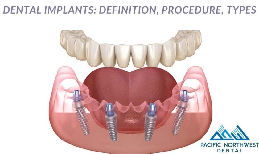 dental implants in Beaverton