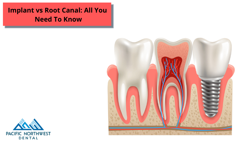 Root Canal vs Implant: Which Is Best?