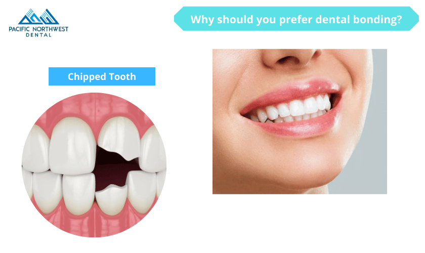Featured image for “Why should you prefer dental bonding?”
