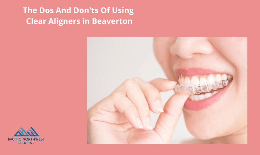 Featured image for “The Dos And Don’ts Of Using Clear Aligners in Beaverton”