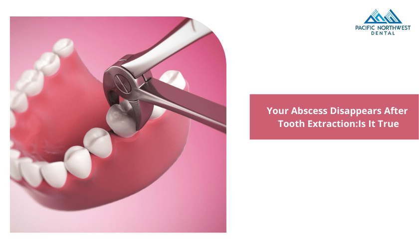 Your Abscess Disappears After Tooth Extraction: Is It True