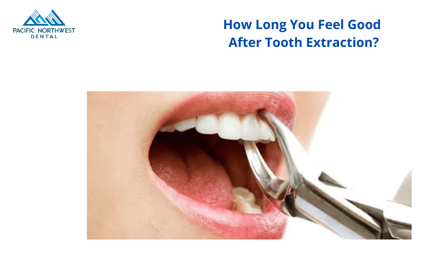 Featured image for “How Long You Feel Good After Tooth Extraction?”
