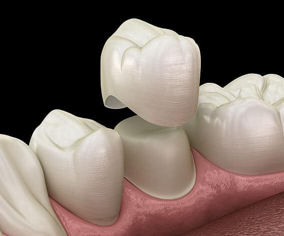 Dental Crowns & Bridges for protecting a cracked tooth