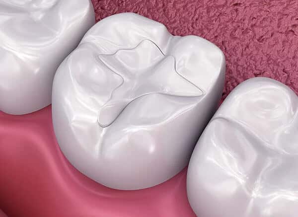 Dental fillings restore treatment