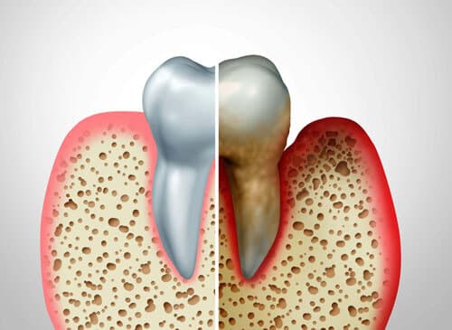 This image describes preventative oral health