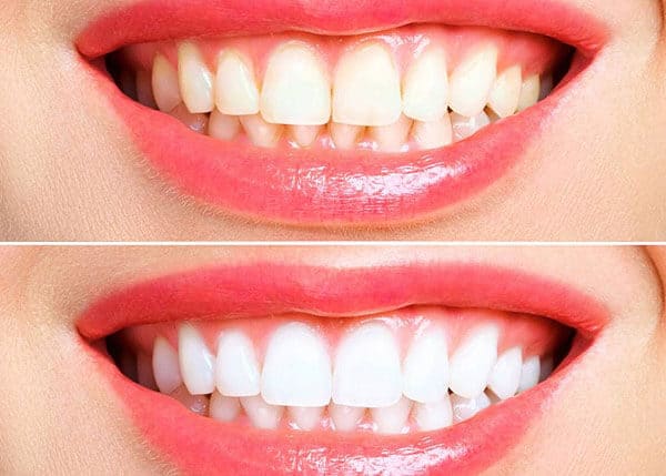 Teeth whitening Therapy