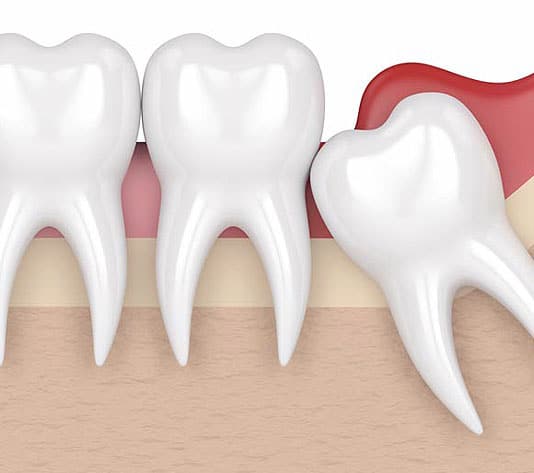 Wisdom teeth extractions for batter outcome