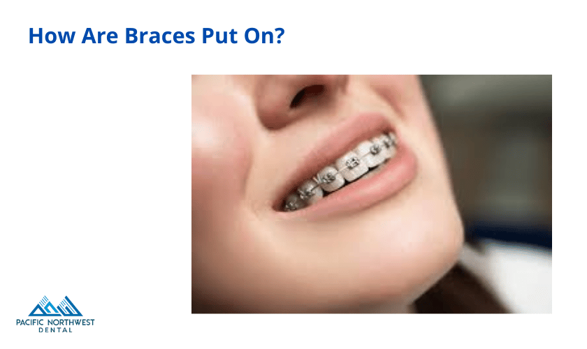 Featured image for “How Are Braces Put On?”