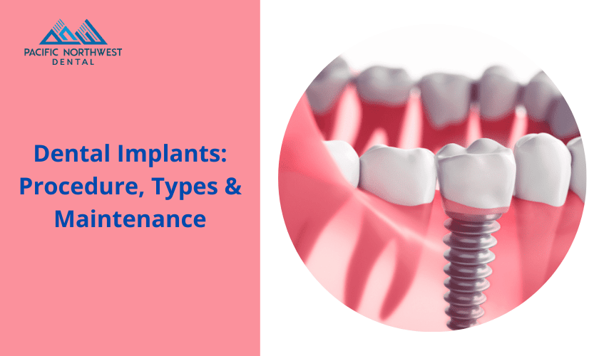 Featured image for “Dental Implants: Procedure, Types & Maintenance”