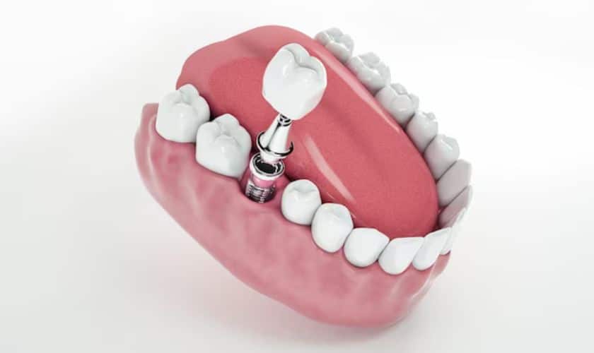 Featured image for “Dental Implants: When And Why They Are Needed”