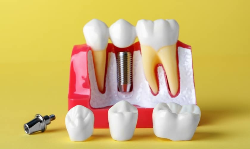 Dental Implants in Beaverton, OR | Pacific Northwest Dental - Dentist Beaverton