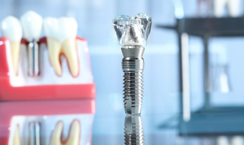 Elevate Your Smile: Choosing The Right Dental Implants Provider In Beaverton
