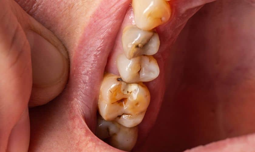 Featured image for “How To Get Rid of Black Spots On Teeth Near Gums”