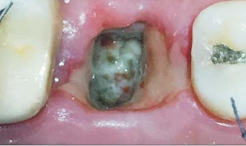 Featured image for “Dry Socket: Symptoms, Causes,and Treatment”