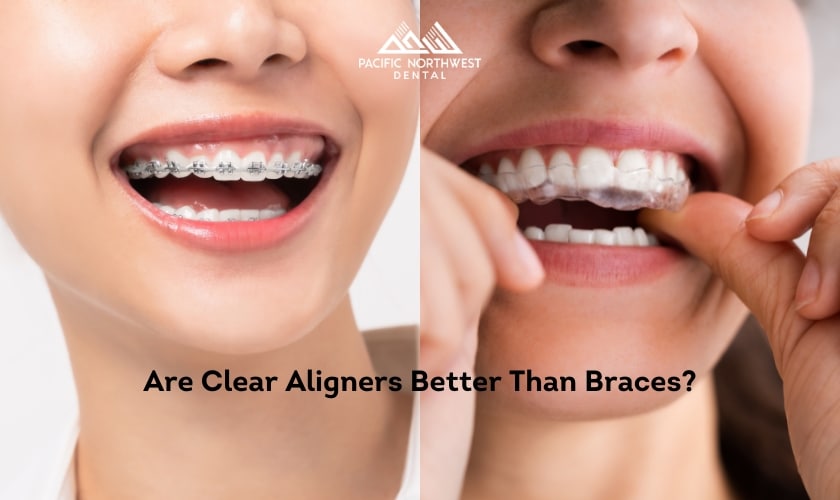 Featured image for “Are Clear Aligners Better Than Braces?”