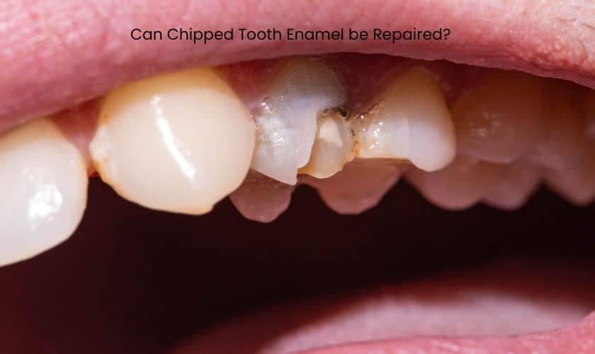 Can Chipped Tooth Enamel be Repaired?