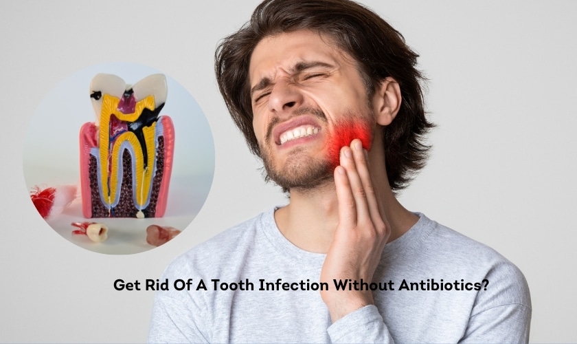 How To Get Rid Of A Tooth Infection Without Antibiotics?