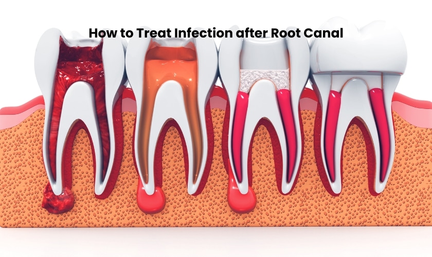 How to Treat Infection after Root Canal