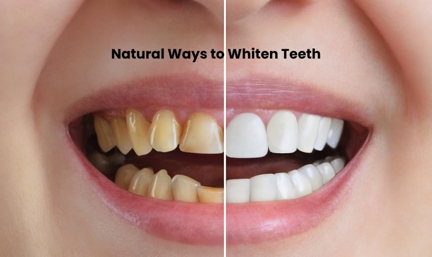Natural Ways to Whiten Teeth - Pacific Northwest Dental