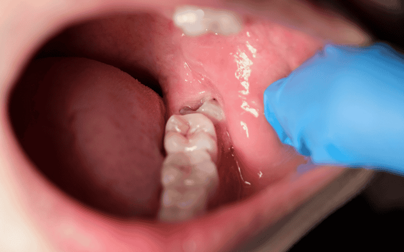 why wisdom teeth removal necessary