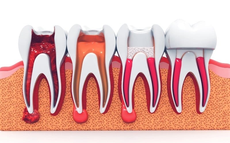 Featured image for “Signs You Might Need a Root Canal: What to Watch For”