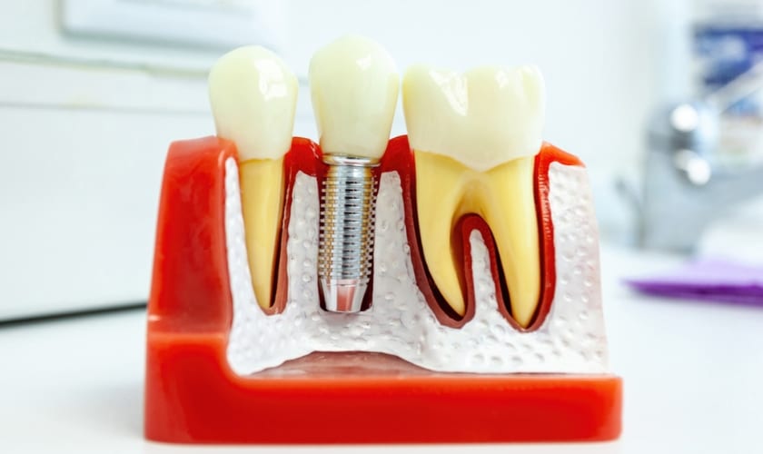 Featured image for “Follow-Up Care Guide for Dental Implants by Pacific Northwest Dental: Maintaining Your New Smile”