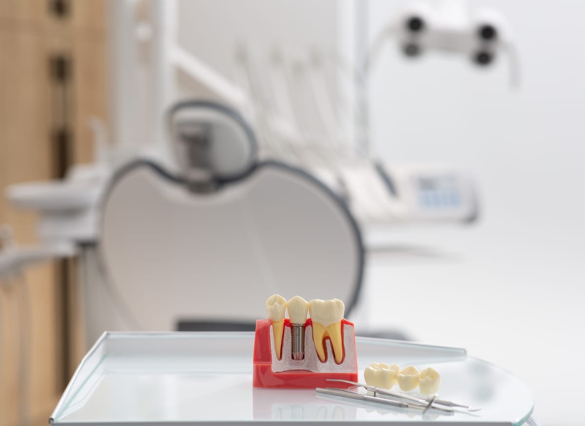 Dental Implants in Beaverton