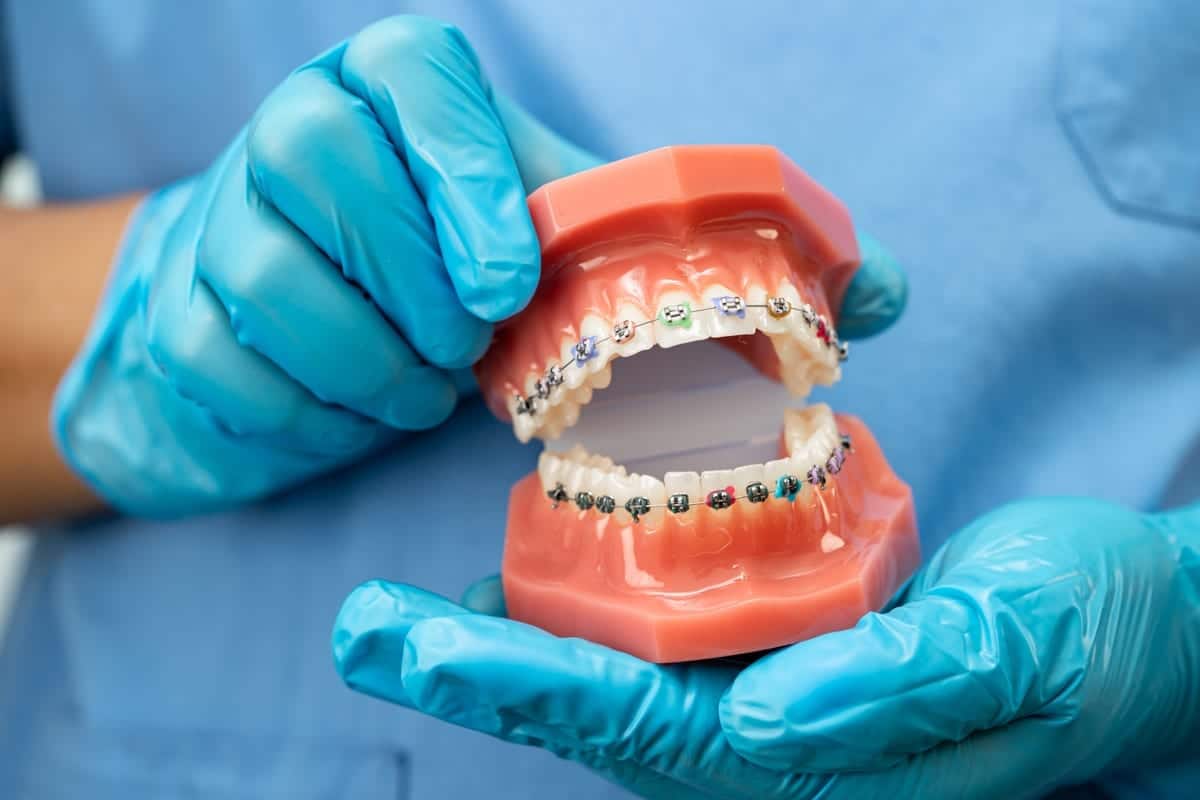 Featured image for “Do Braces Results Really Last Forever? What Matters Most”